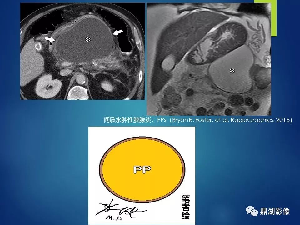 【PPT】急性胰腺炎2012新亚特兰大分类：影像科医生需知道什么