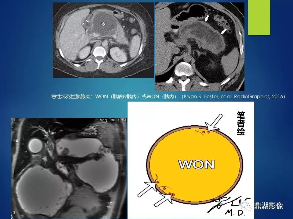 【PPT】急性胰腺炎2012新亚特兰大分类：影像科医生需知道什么
