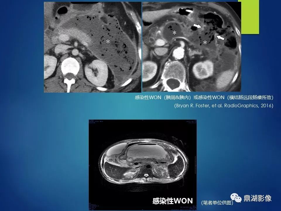 【PPT】急性胰腺炎2012新亚特兰大分类：影像科医生需知道什么