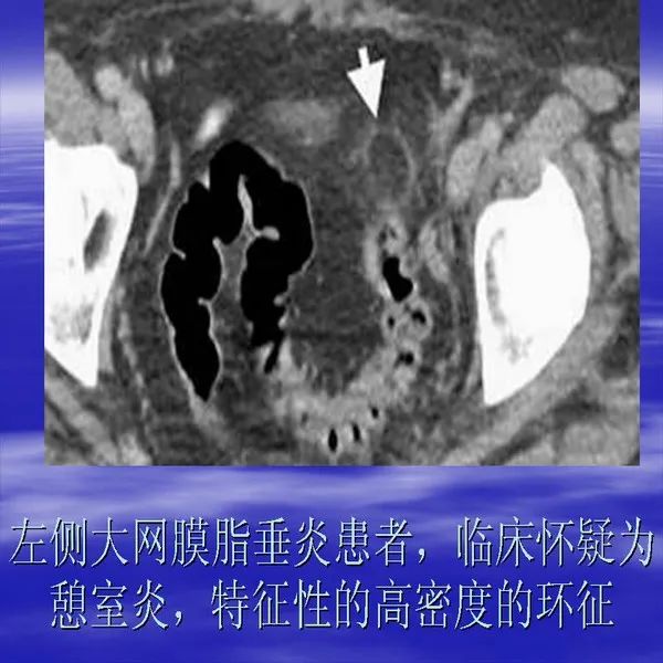 【PPT】急腹症影像诊断与鉴别诊断