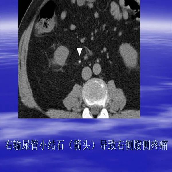 【PPT】急腹症影像诊断与鉴别诊断