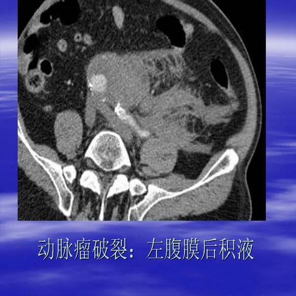 【PPT】急腹症影像诊断与鉴别诊断