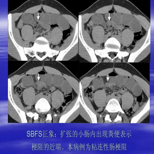 【PPT】急腹症影像诊断与鉴别诊断
