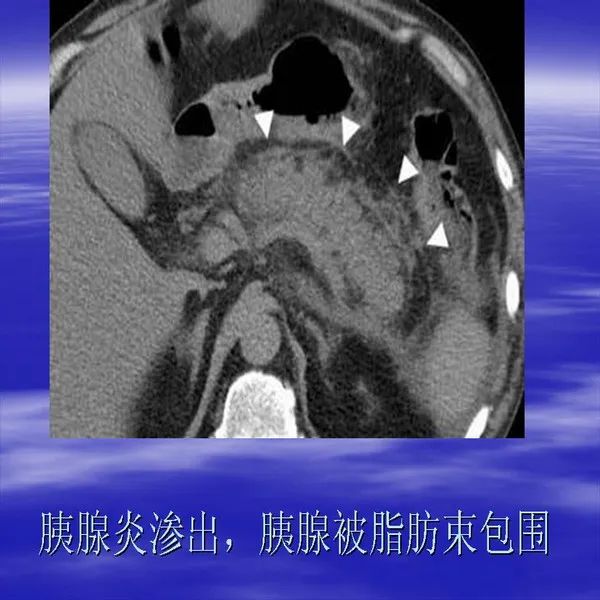 【PPT】急腹症影像诊断与鉴别诊断