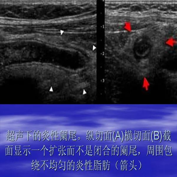 【PPT】急腹症影像诊断与鉴别诊断
