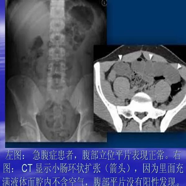 【PPT】急腹症影像诊断与鉴别诊断