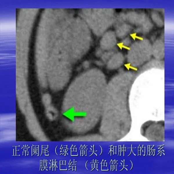 【PPT】急腹症影像诊断与鉴别诊断