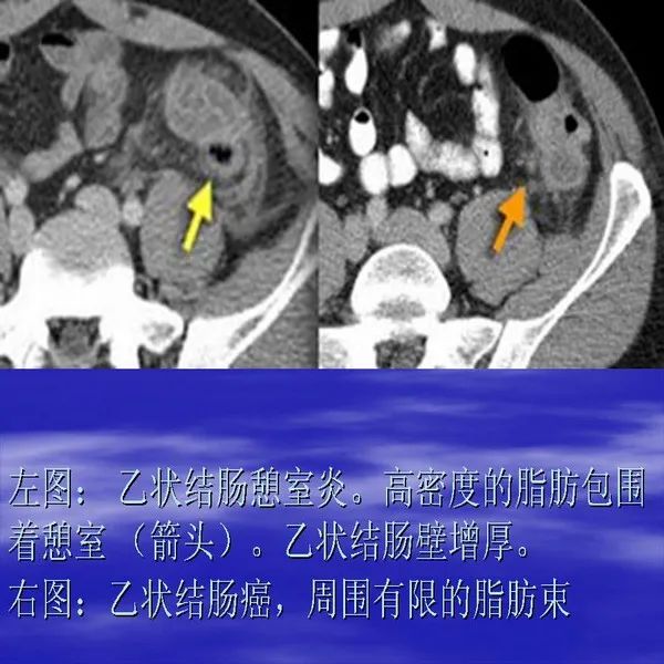 【PPT】急腹症影像诊断与鉴别诊断