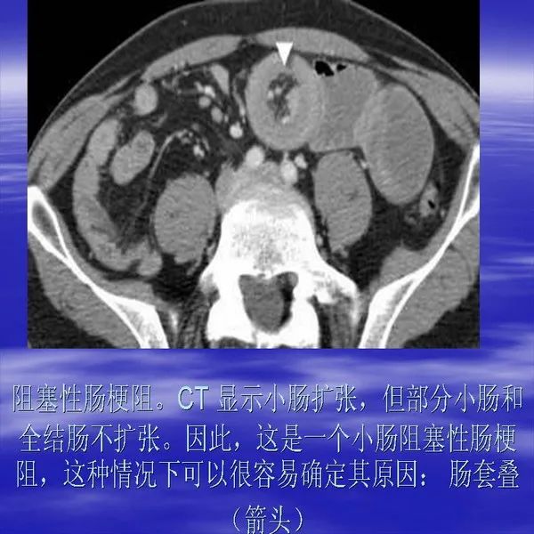 【PPT】急腹症影像诊断与鉴别诊断