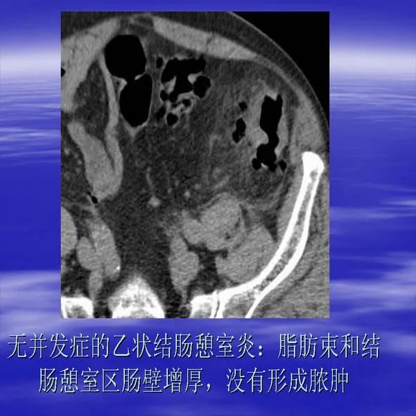 【PPT】急腹症影像诊断与鉴别诊断