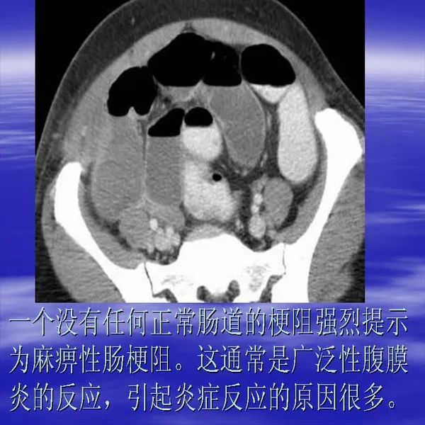 【PPT】急腹症影像诊断与鉴别诊断