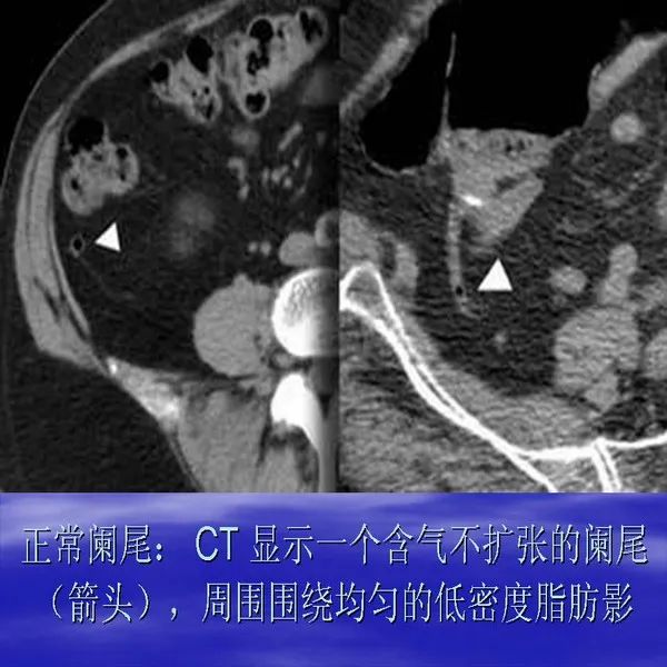 【PPT】急腹症影像诊断与鉴别诊断