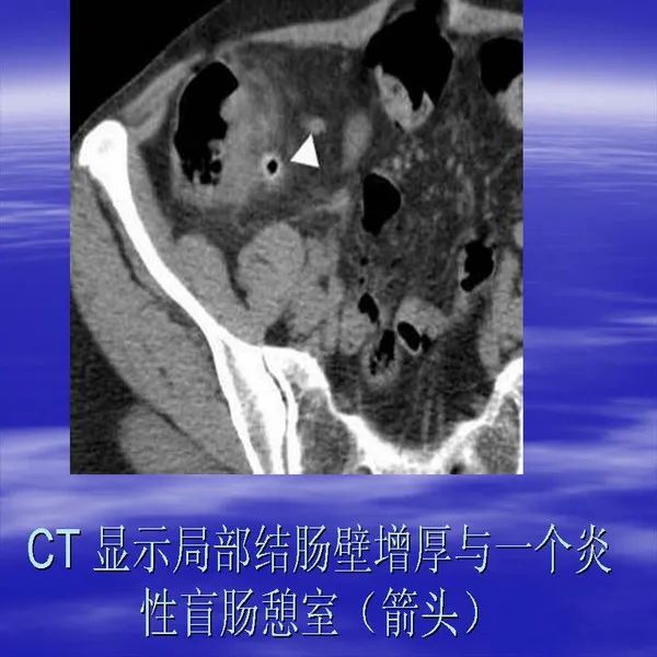 【PPT】急腹症影像诊断与鉴别诊断