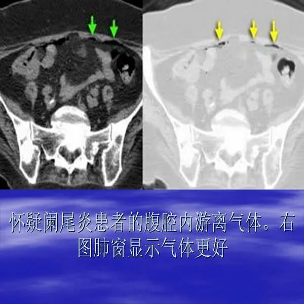 【PPT】急腹症影像诊断与鉴别诊断