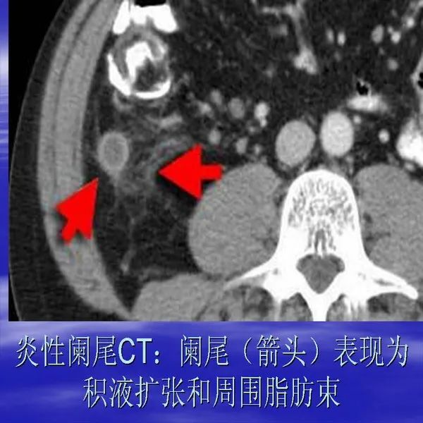 【PPT】急腹症影像诊断与鉴别诊断