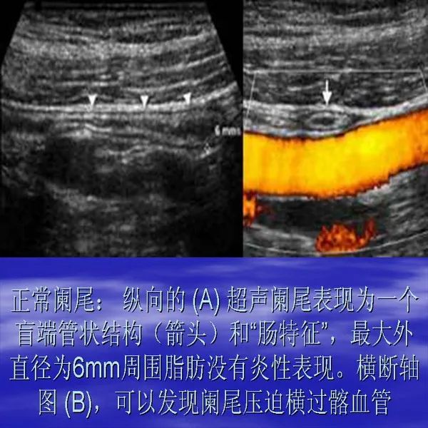 【PPT】急腹症影像诊断与鉴别诊断