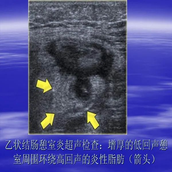 【PPT】急腹症影像诊断与鉴别诊断