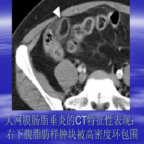 【PPT】急腹症影像诊断与鉴别诊断