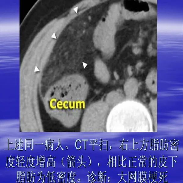 【PPT】急腹症影像诊断与鉴别诊断