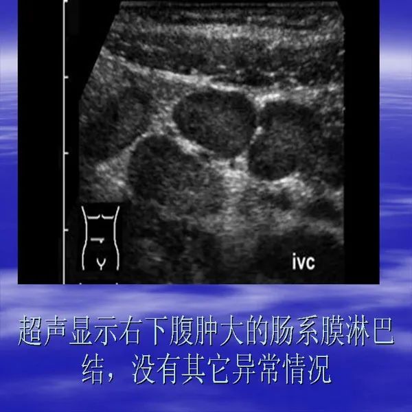 【PPT】急腹症影像诊断与鉴别诊断
