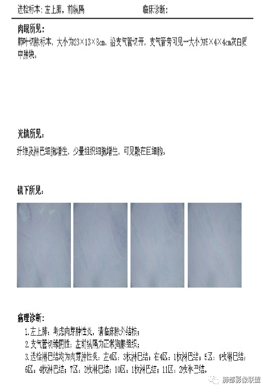 【病例】易误诊的肺结核1例CT影像讨论