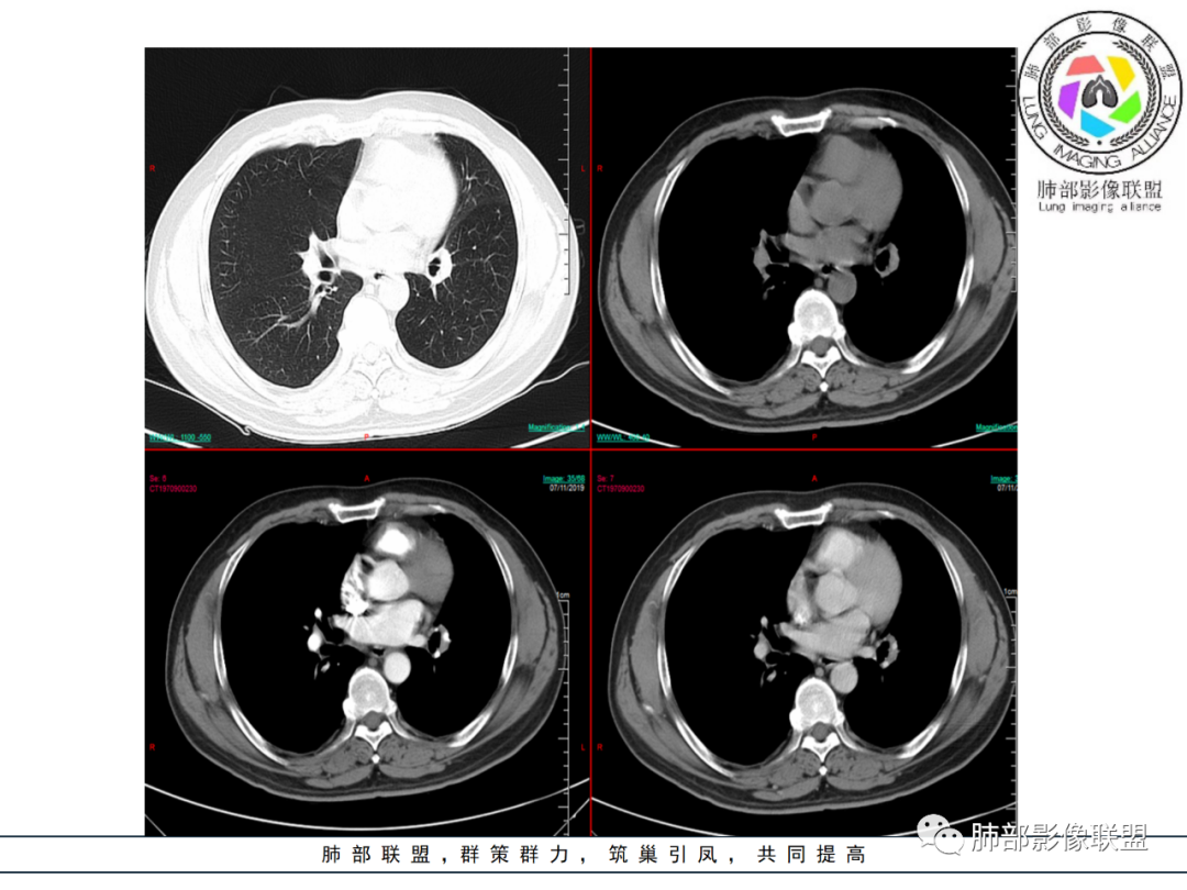 【病例】易误诊的肺结核1例CT影像讨论 【病例】易误诊的肺结核1例CT影像讨论