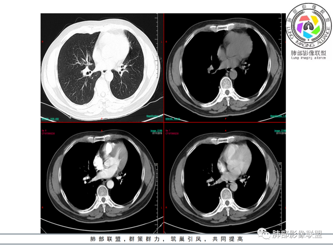 【病例】易误诊的肺结核1例CT影像讨论