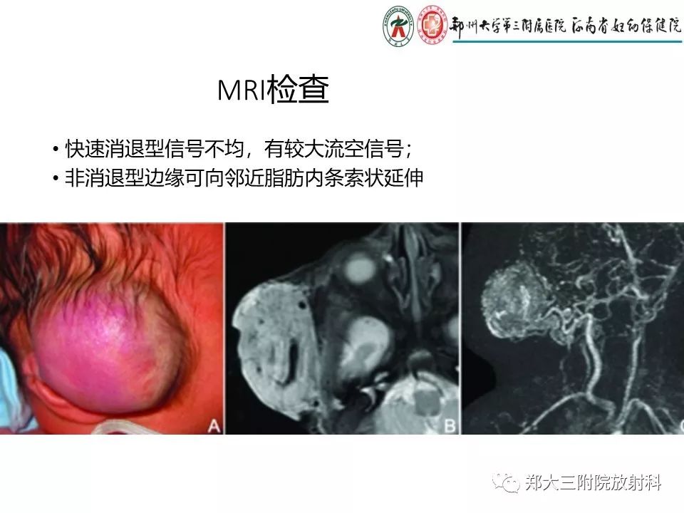 【PPT】浅谈血管瘤和脉管畸形的临床和MRI检查