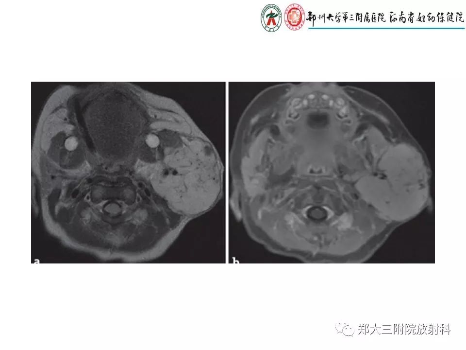【PPT】浅谈血管瘤和脉管畸形的临床和MRI检查