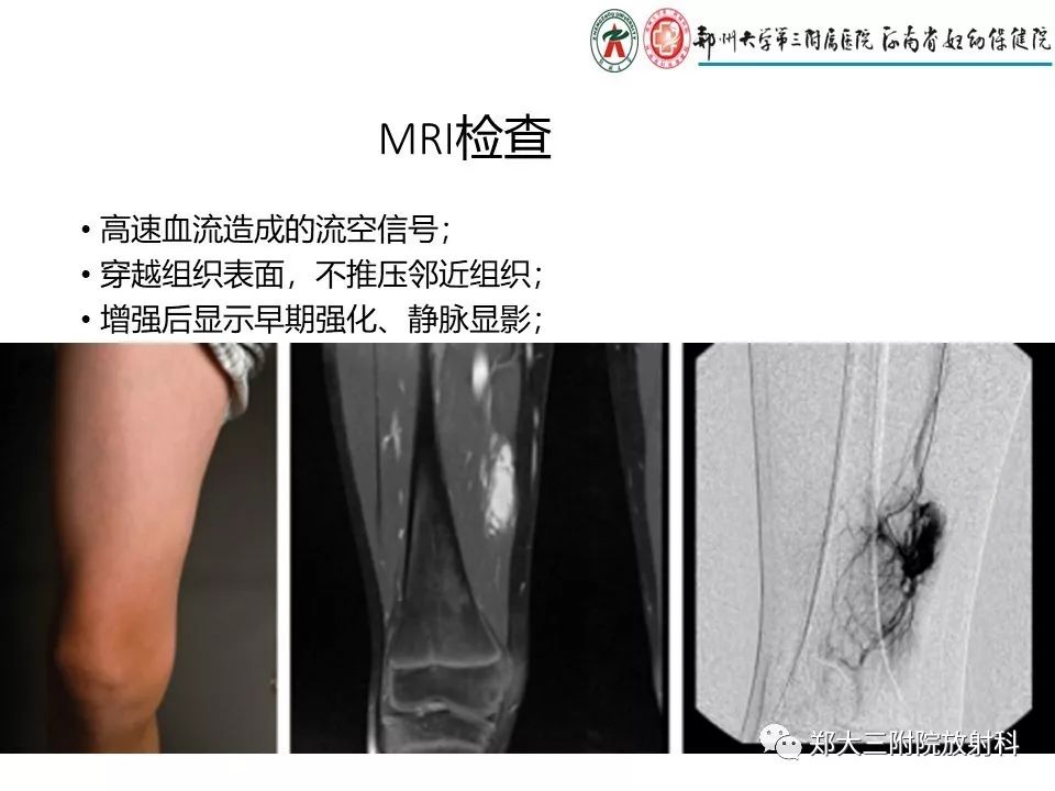 【PPT】浅谈血管瘤和脉管畸形的临床和MRI检查