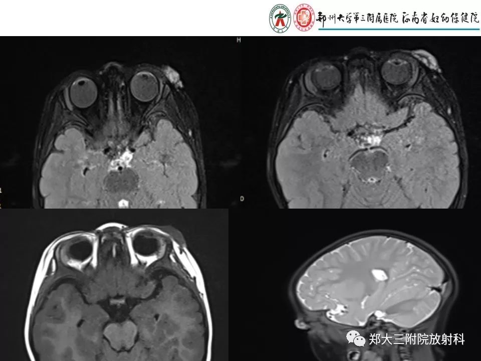 【PPT】浅谈血管瘤和脉管畸形的临床和MRI检查