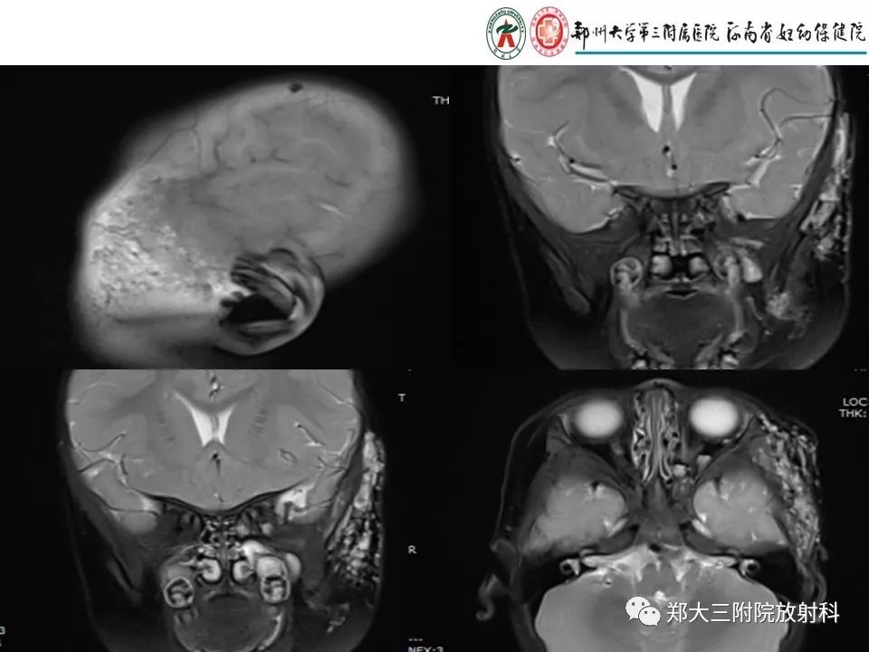 【PPT】浅谈血管瘤和脉管畸形的临床和MRI检查