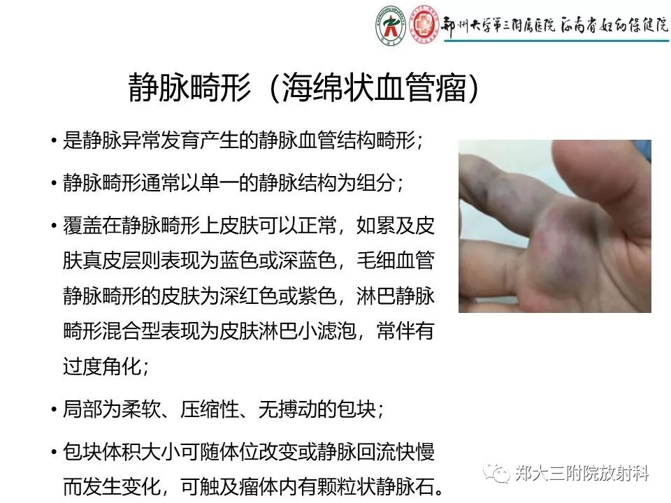 【PPT】浅谈血管瘤和脉管畸形的临床和MRI检查
