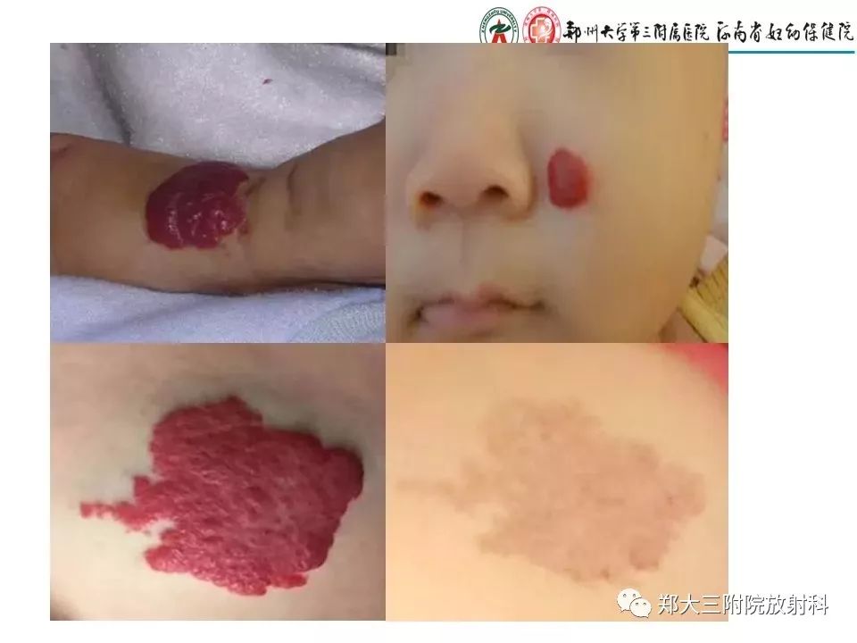 【PPT】浅谈血管瘤和脉管畸形的临床和MRI检查
