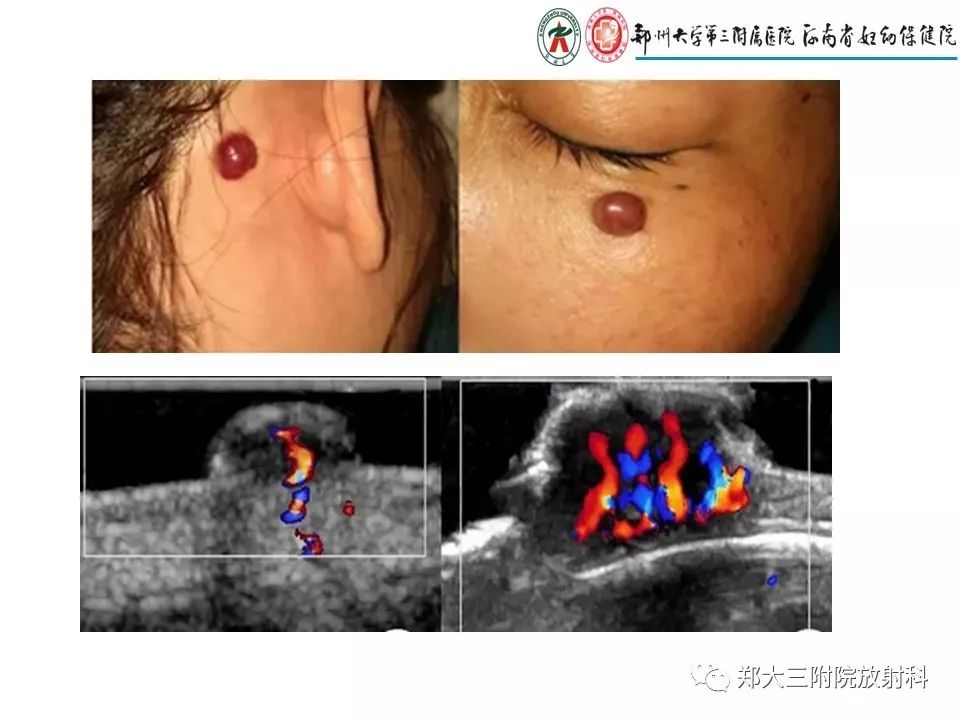 【PPT】浅谈血管瘤和脉管畸形的临床和MRI检查