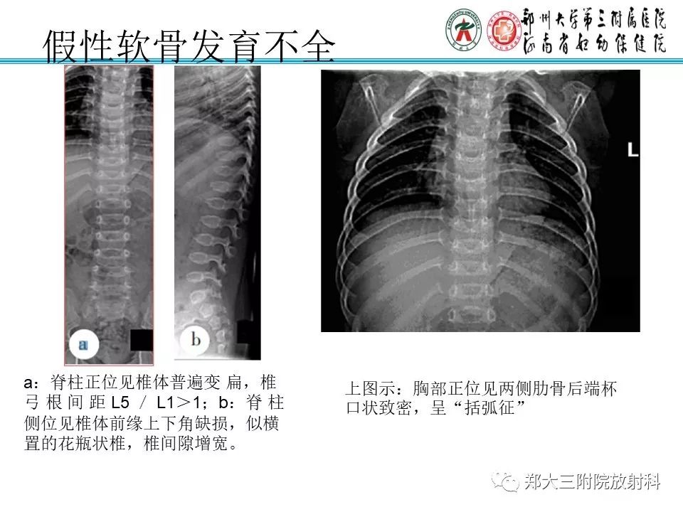 【PPT】儿童先天性骨软骨发育障碍性疾病影像诊断
