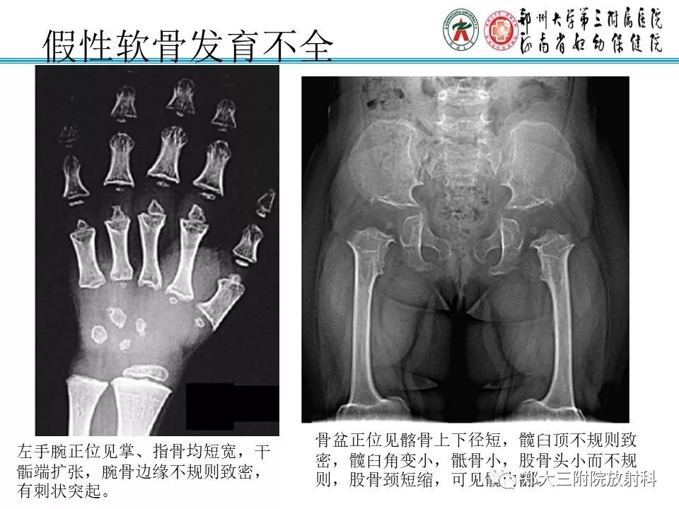 【PPT】儿童先天性骨软骨发育障碍性疾病影像诊断