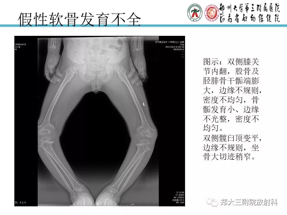 【PPT】儿童先天性骨软骨发育障碍性疾病影像诊断