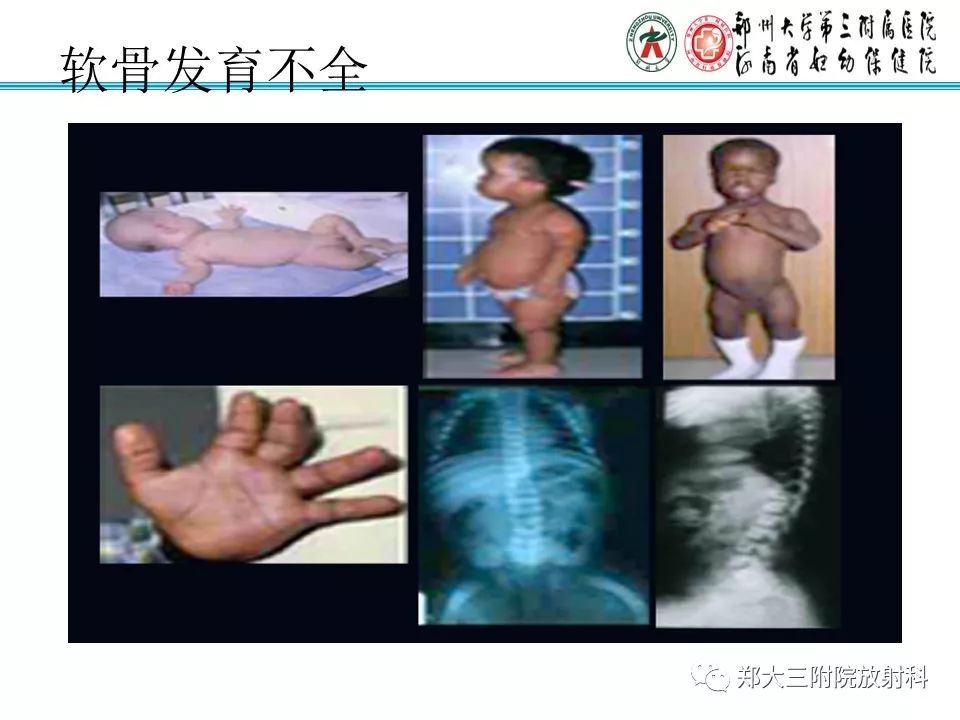 【PPT】儿童先天性骨软骨发育障碍性疾病影像诊断