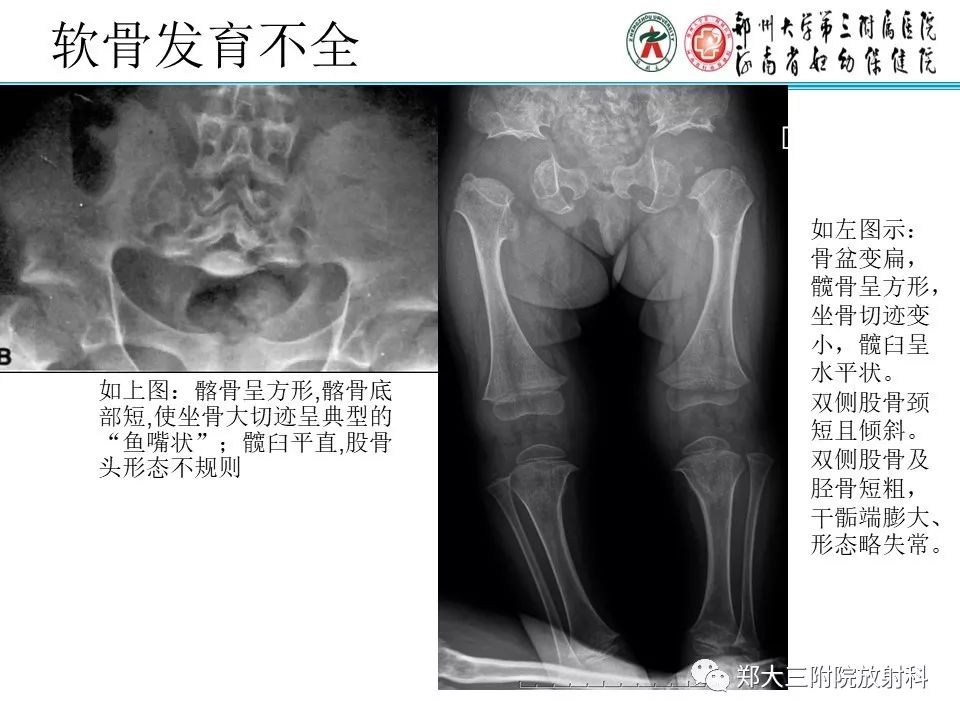 【PPT】儿童先天性骨软骨发育障碍性疾病影像诊断