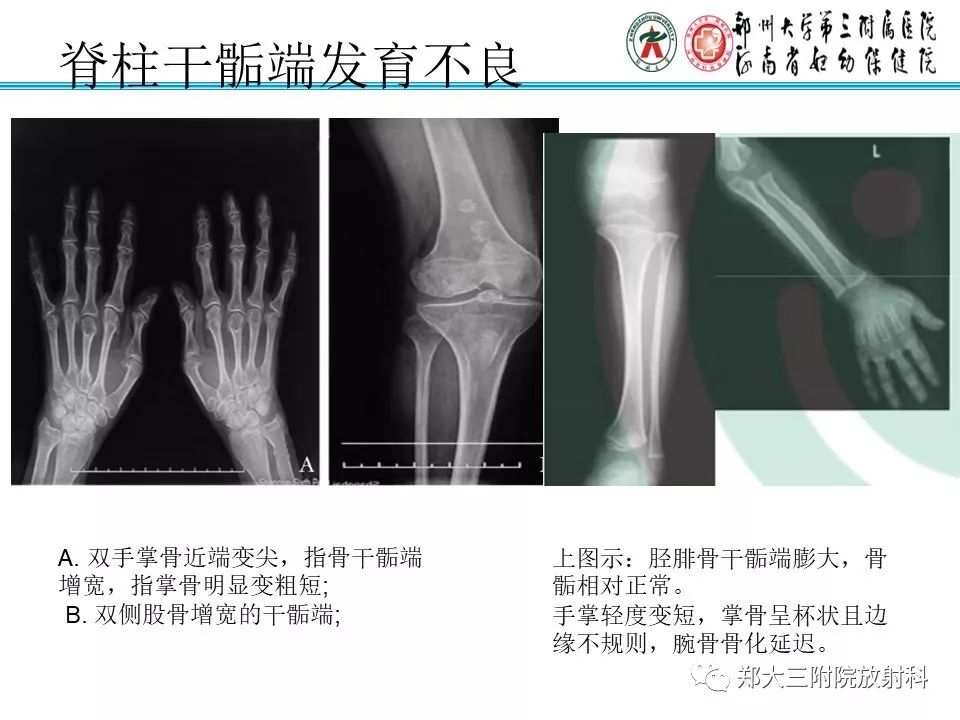 【PPT】儿童先天性骨软骨发育障碍性疾病影像诊断