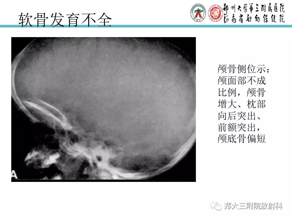 【PPT】儿童先天性骨软骨发育障碍性疾病影像诊断