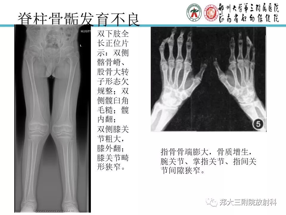 【PPT】儿童先天性骨软骨发育障碍性疾病影像诊断