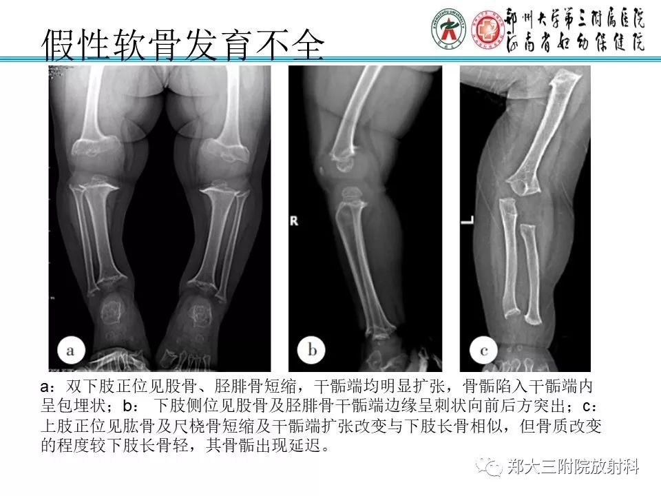 【PPT】儿童先天性骨软骨发育障碍性疾病影像诊断