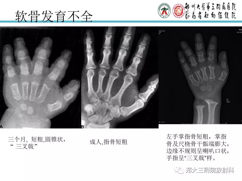 【PPT】儿童先天性骨软骨发育障碍性疾病影像诊断