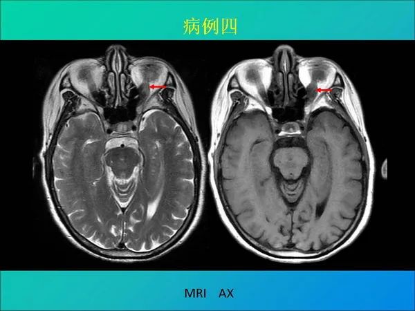 【PPT】常见眶内肿瘤影像诊断与鉴别诊断