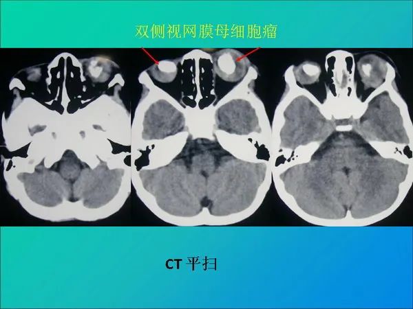 【PPT】常见眶内肿瘤影像诊断与鉴别诊断