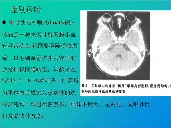 【PPT】常见眶内肿瘤影像诊断与鉴别诊断