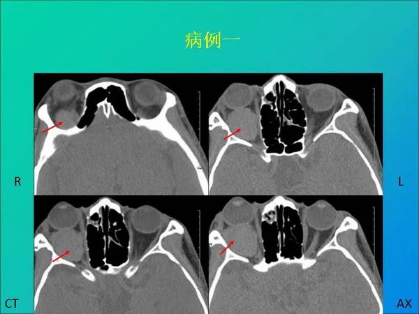 【PPT】常见眶内肿瘤影像诊断与鉴别诊断