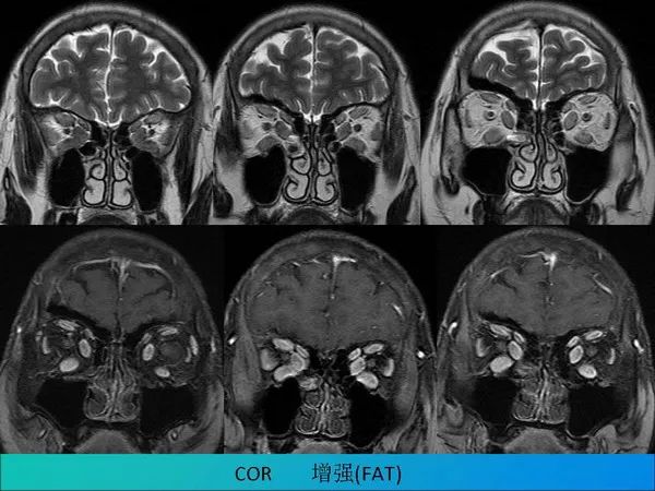 【PPT】常见眶内肿瘤影像诊断与鉴别诊断